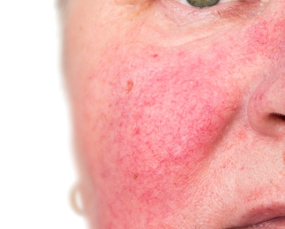 What Is Rosacea
