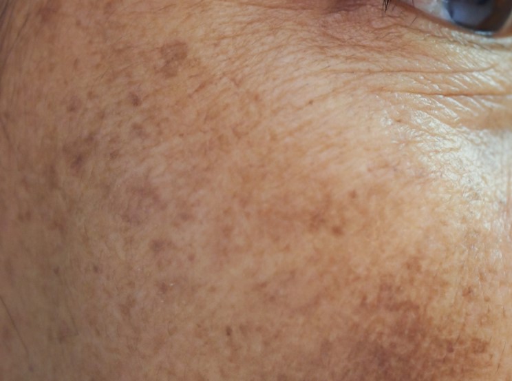 What Is Pigmentation