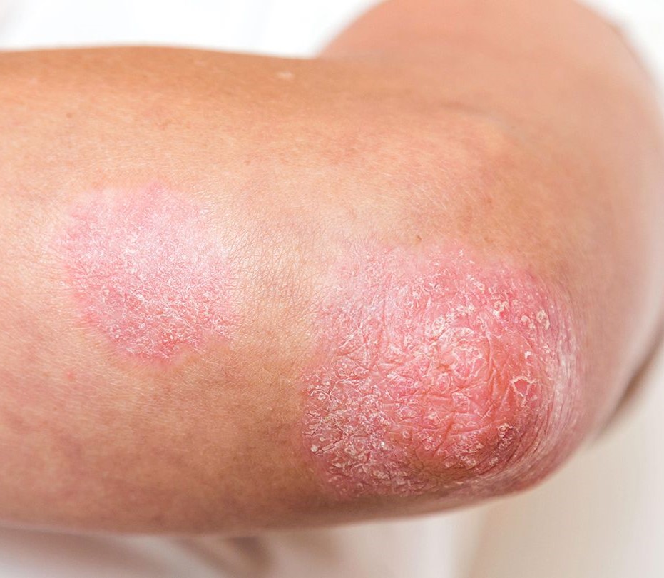 What Is Psoriasis